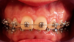 occlusion dentaire anormale