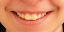 sourire en post-opératoire