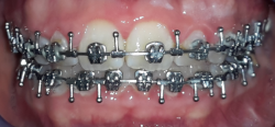 occlusion dentaire normale
