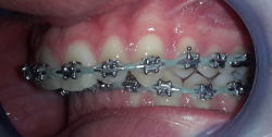 occlusion dentaire anormale